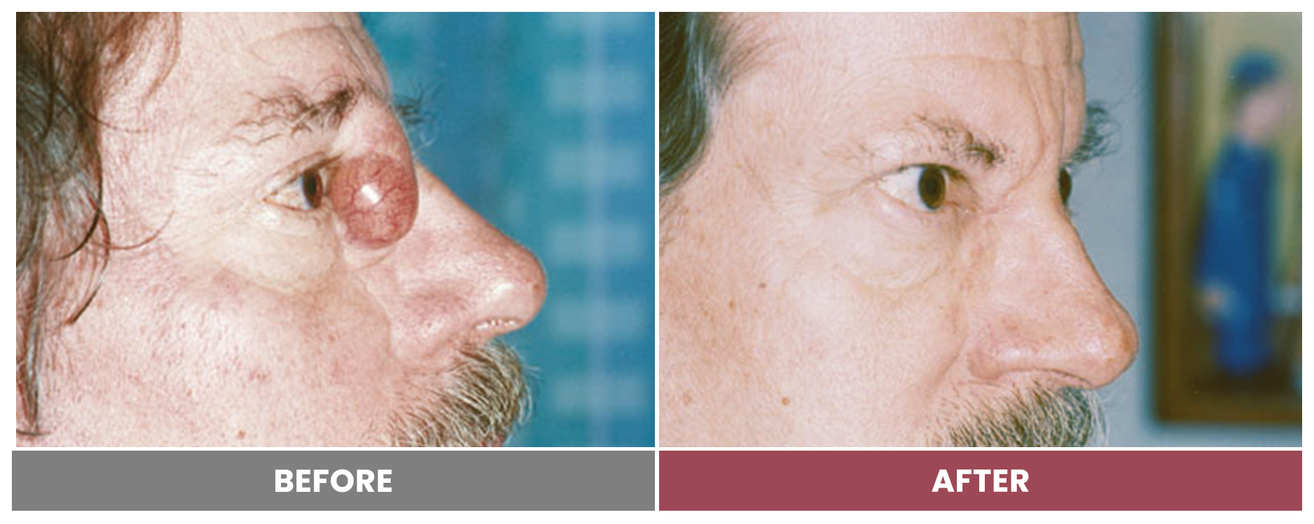 TUMOR REMOVAL AND RECONSTRUCTION - Case 4